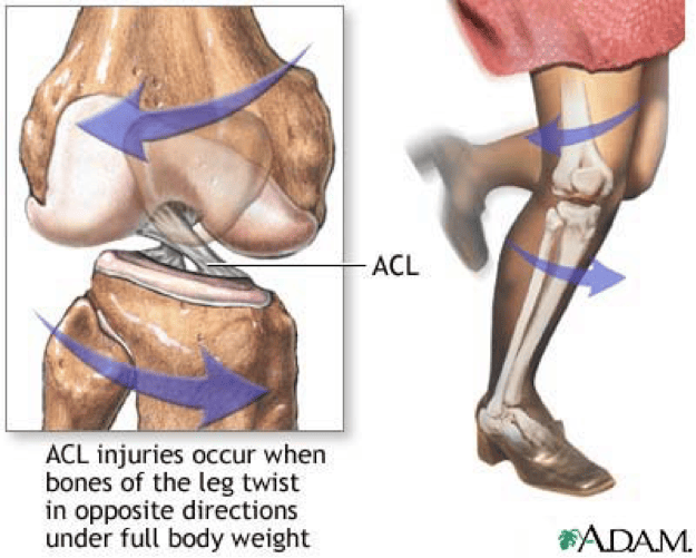 ACL-injuries2
